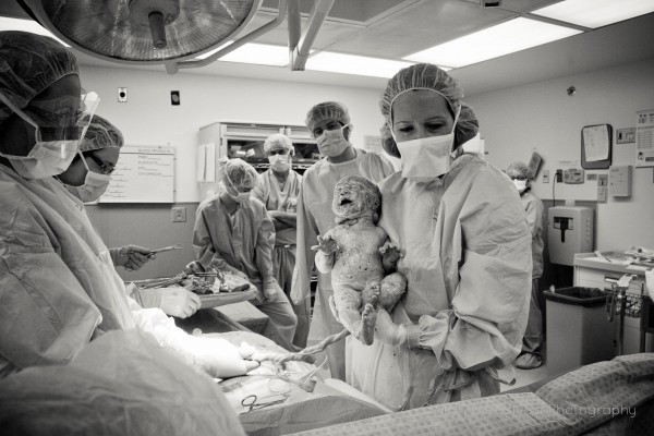 C-Section Birth Photo